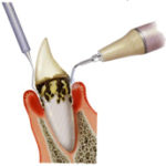 1日で歯が入るインプラント治療｜歯周病なので歯の掃除を定期的にしていたが歯を抜かないといけなくなった方へ
