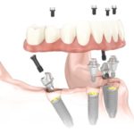 オールオン４インプラントとは全ての歯を失った方に１日で歯の機能や見た目を回復する治療です
