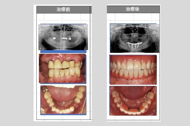 １日で仮歯が入るオールオン４インプラント｜香川県高松市の吉本歯科医院